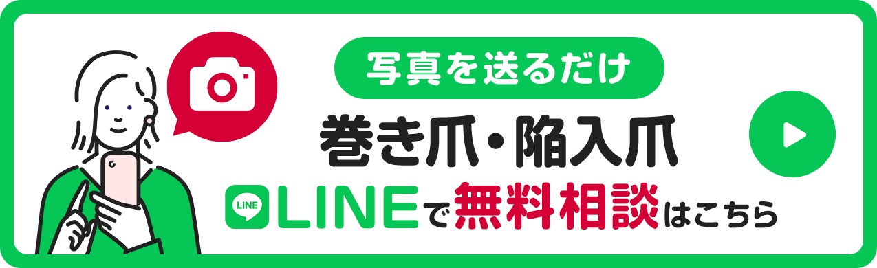 写真を送るだけ 巻き爪・陥入爪 LINEで無料相談はこちら